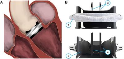 Fluid-structure interaction simulation of mechanical aortic valves: a narrative review exploring its role in total product life cycle